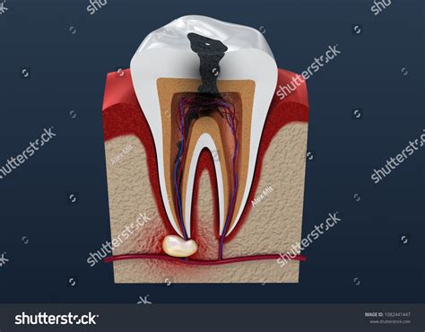 Tooth Decay 3d Illustration Stock Illustration 1082441447 | Shutterstock