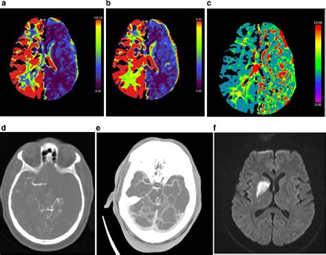 Figure 1 from Unusual CT perfusion imaging pattern with normal CT angiography due to unintended ...