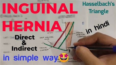 Inguinal Hernia Anatomy 12 Direct And Indirect Inguinal Hernia