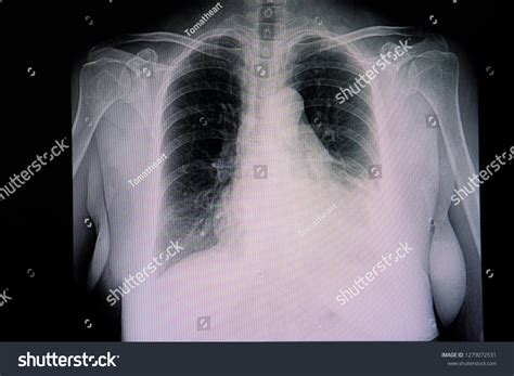 Chest Xray Film Patient Cardiomegaly Left Stock Photo 1279072531