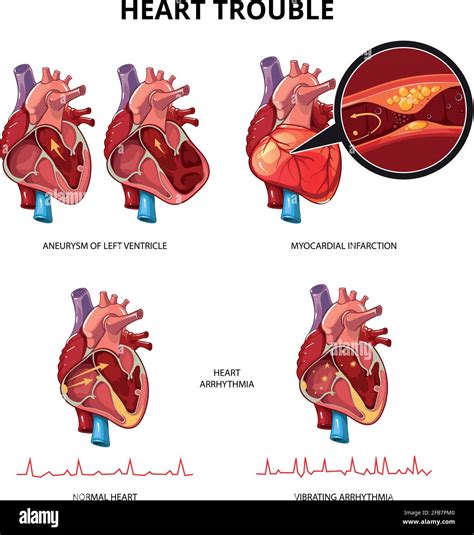 Diseased Human Heart Images