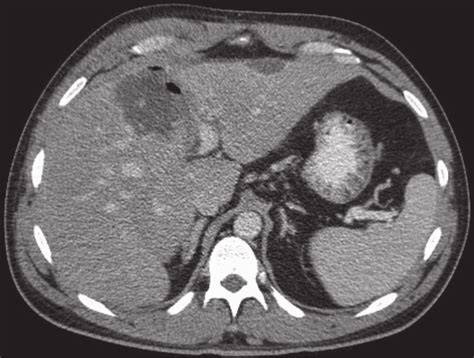 Contrast Enhanced Abdominal Computed Tomography Demonstrating A