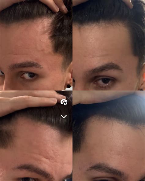 3 Month Minoxidil Results 2x A Day 5 Concentration Do You Think My Hairline Will Continue To