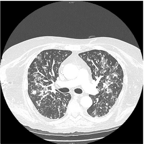 Figure 3 From Diagnosis Of Disseminated Tuberculosis From A Lesion In