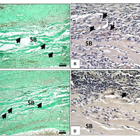 A Cellular And Connective Tissue Infiltration Black Arrows Of The