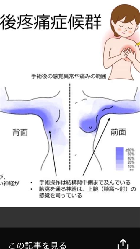 腋窩リンパ節郭清後の感覚異常とは？経験者が語る違和感 | ステージⅣHER2陽性乳がん〜告知から完治まで〜