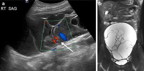 Mucinous Cystadenoma In An 11 Year Old Girl A B Sagittal Doppler