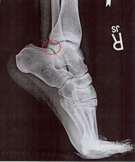 Insertional Achilles Tendinopathy Differential Diagnosis And Treatment By Seth Oneill And Tom