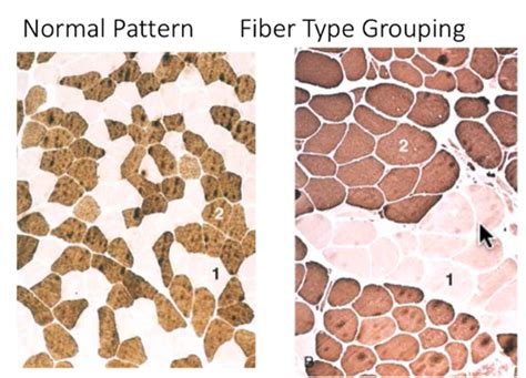 Msk Pathology Skeletal Msucle Flashcards Quizlet