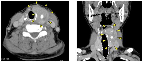 Anaplastic Thyroid Cancer With Long‑term Survival With Lenvatinib