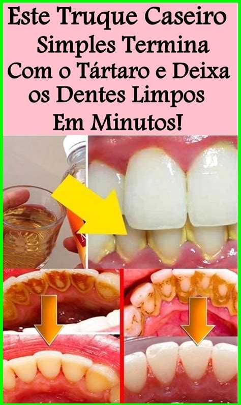 Receita Caseira Para Remover Os T Rtaros Dos Dentes Em Minutos Em