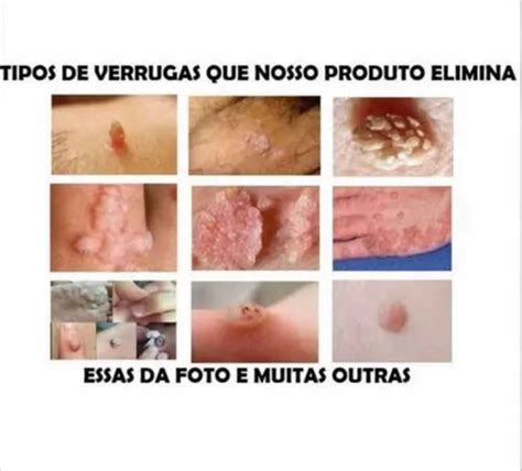 Hpv Fotos Femininas Tratamento - Verrugas Genital Hpv Condilomas Produto Para Eliminação 10ml Neutra ...