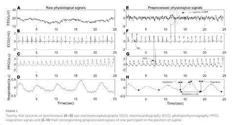 Figure 1 From Effects Of 24 H Acute Total Sleep Deprivation On