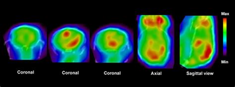 Frontiers Precision Medicine In Multiple Sclerosis Future Of Pet