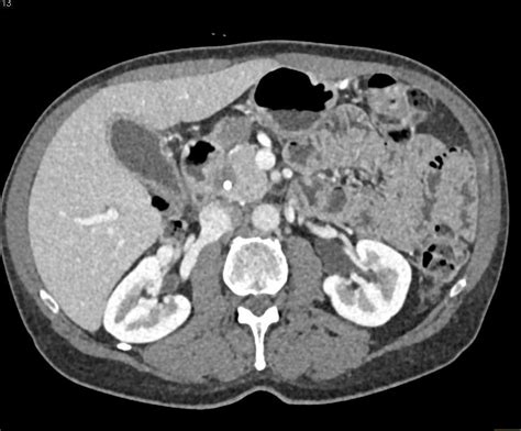 Pancreatic Cancer With Common Bile Duct Cbd Stent Pancreas Case