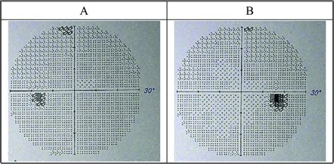 Postoperative visual field. A: Oculus Sinister (O.S), B: Oculus Dexter ...