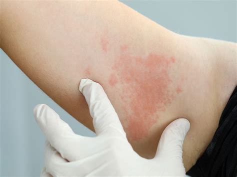 How To Treat Eczema On Elbows