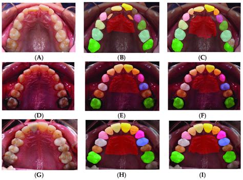 Individual Teeth Labeling Results For Segnet Including Rotation