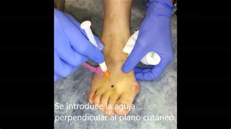 Infiltración neuroma Morton YouTube