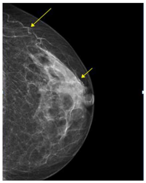 Electronics Free Full Text Detecting Breast Arterial Calcifications