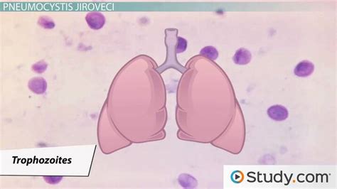 Pneumocystis Jirovecii