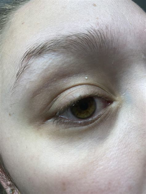 Skin Concerns Any Idea What This Raised White Bump On My Eyelid Could Be Just Appeared About