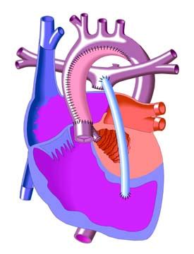 Sano Shunt Procedure