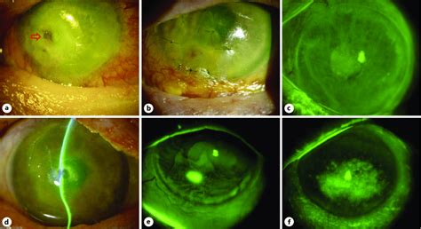 An Overview Obtained By Slit Lamp Photography Of The Ocular And