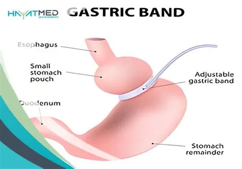 Gastric Sleeve Vs Gastric Bypass Ultimate 2024 Comparison