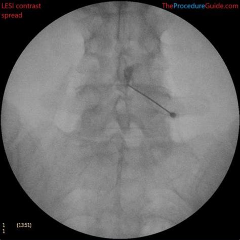 Fluoroscopic Guided Hip Joint Injection - Technique and Overview - The ...