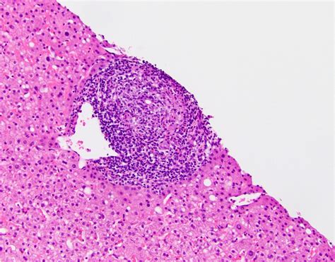 Primary Sclerosing Cholangitis Histology