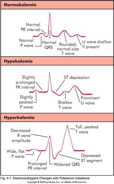 Ecg Changes With Potassium K Imbalance Medizzy