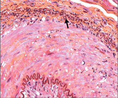 Findings on Temporal-Artery Biopsy. A mononuclear inflammatory ...