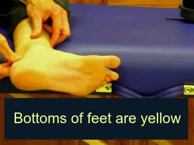 Yellow Feet Problem Causes And Treatment Health Advisor