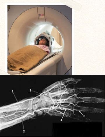 Mri Scan For Upper Limb Angiography Hyderabad Medintu