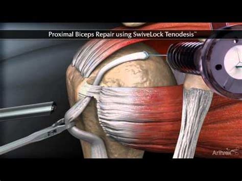 Proximal Biceps Repair Using Swivelock Tenodesis Youtube