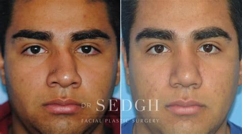 Crooked Nose Surgery Before After Photos Dr Sedgh