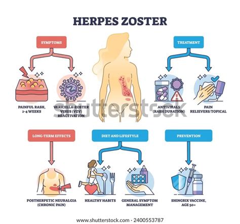 Herpes Zoster Infection Medical Symptoms Treatment Stock Vector ...