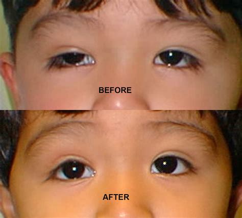 Ptosis Treatment For Congenital Ptosis Drooping Eyelids Surgery