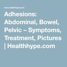 Adhesions: Abdominal, Bowel, Pelvic – Symptoms, Treatment, Pictures | Healthhype.com Health Tips ...