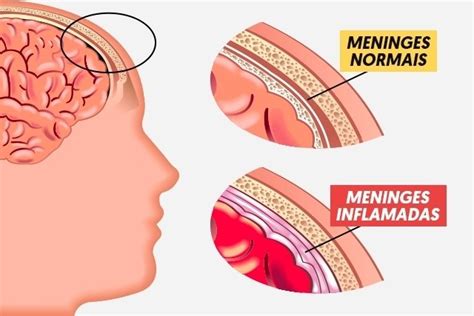 Como é a transmissão da Meningite C e como prevenir Tua Saúde