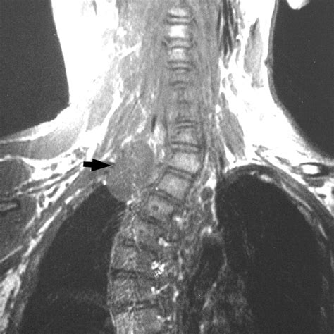 Mr Imaging Of Spinal Tumors In Children With Neurofibromatosis 1 Ajr