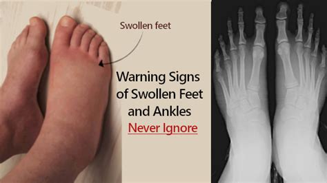 10 Warning Signs Of Swollen Feet And Ankles You Must Know