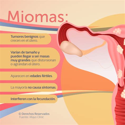 Conoce Las Diferencias Entre Miomas Uterinos Y Quistes Recuerda En