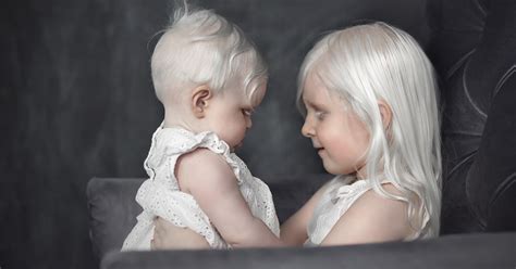 how to become albino