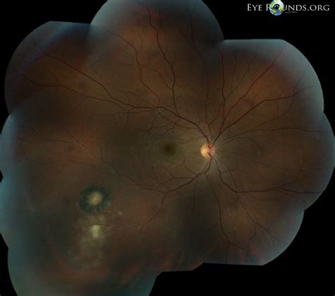 Ocular Toxoplasmosis Symptoms