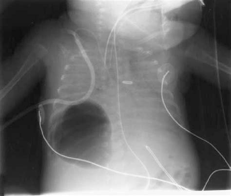 Large, right lower lobe pneumatocele is shown, compromising ventilation ...