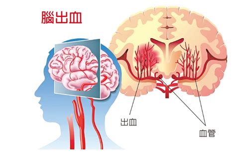 出血性中風 Ccwl