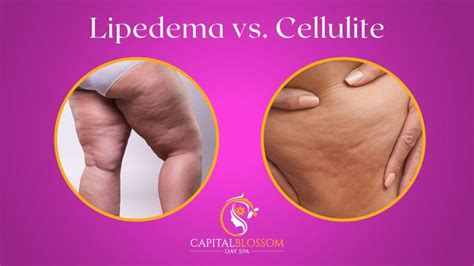 Lipedema Vs Cellulite How To Differentiate And Address Each Condition