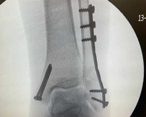 Cirurgia De Tornozelo Com Placa E Pino - Quebrei o Tornozelo: o que devo fazer?